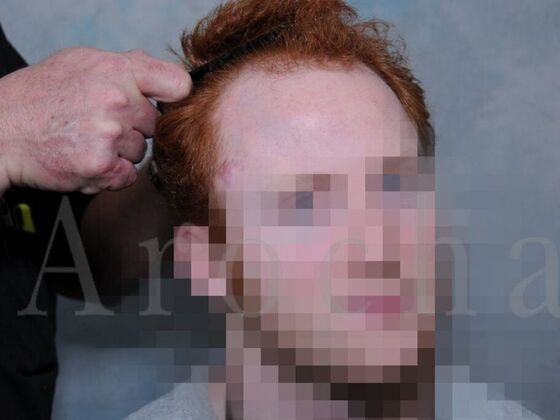 FUT Hair Restoration: Case 1 - Before