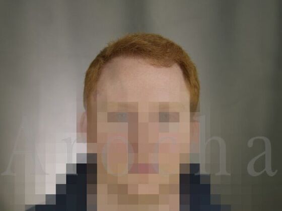 FUT Hair Restoration: Case 1 - After