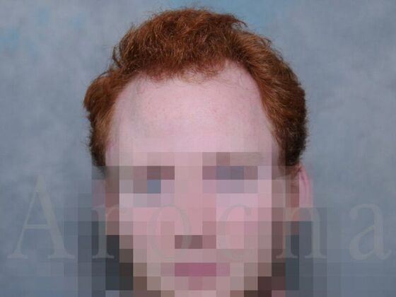 FUT Hair Restoration: Case 1 - Before