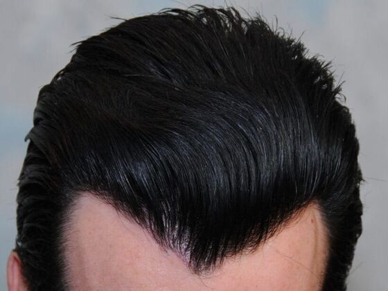 FUT Hair Restoration Case 2 - After