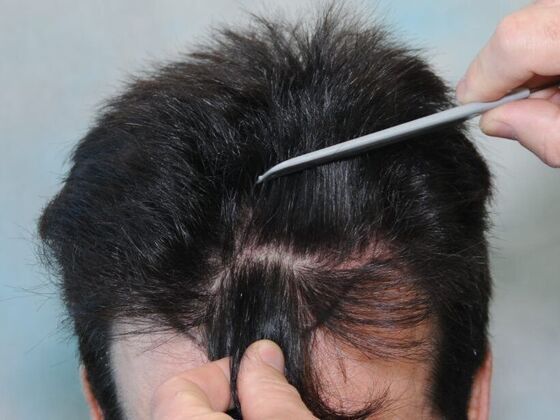 FUT Hair Restoration Case 2 - Before