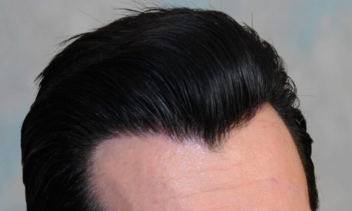 FUT Hair Restoration: Case 2 - After