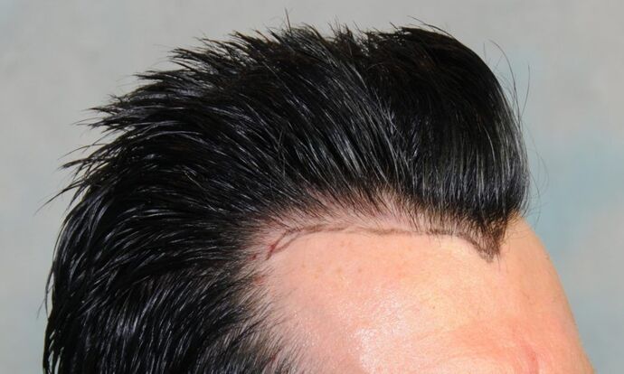 FUT Hair Restoration: Case 2 - Before