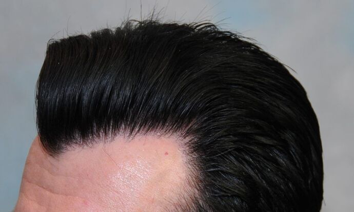 FUT Hair Restoration: Case 2 - After