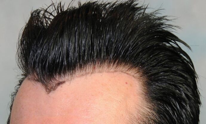 FUT Hair Restoration: Case 2 - Before