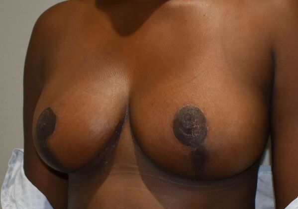 Breast Lift (Mastopexy): Case 159 - After