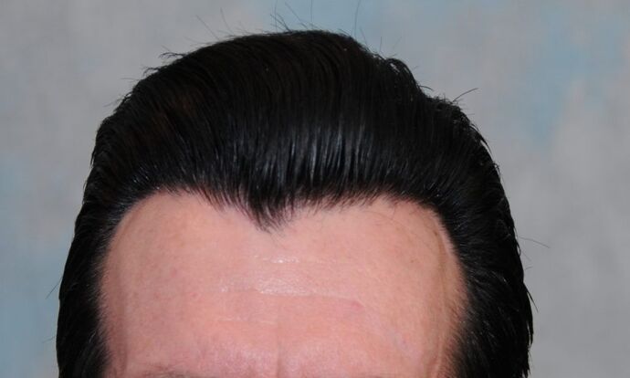 FUT Hair Restoration: Case 2 - After