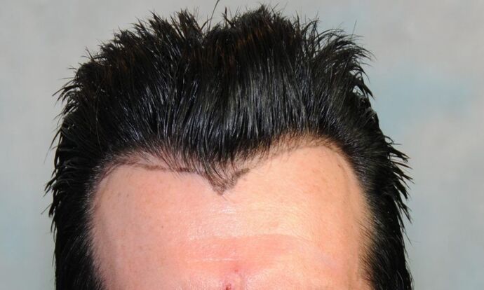 FUT Hair Restoration: Case 2 - Before