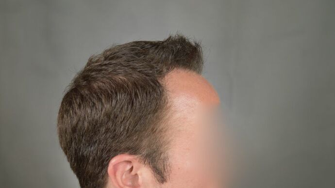 FUT Hair Restoration: Case 3 - After