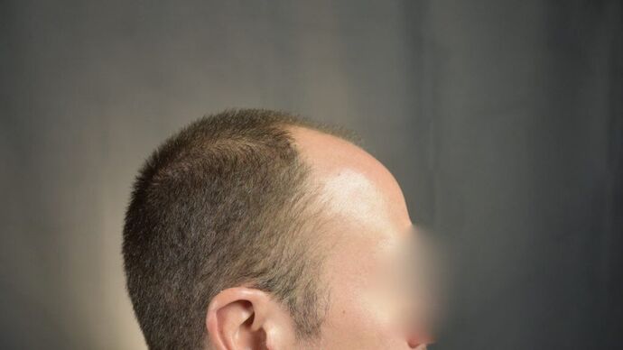 FUT Hair Restoration: Case 3 - Before
