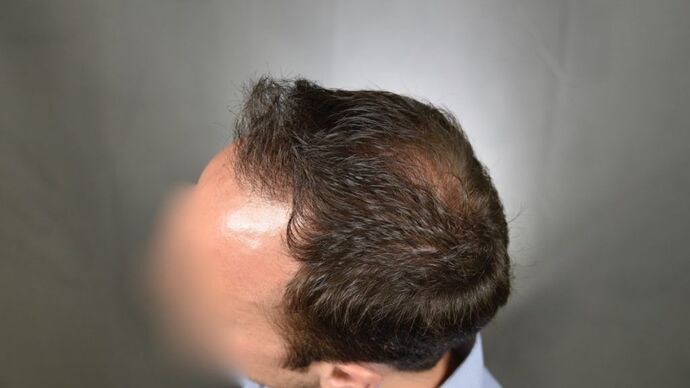 FUT Hair Restoration: Case 3 - After