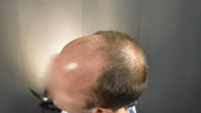 FUT Hair Restoration: Case 3 - Before