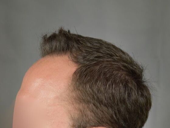 FUT Hair Restoration: Case 3 - After