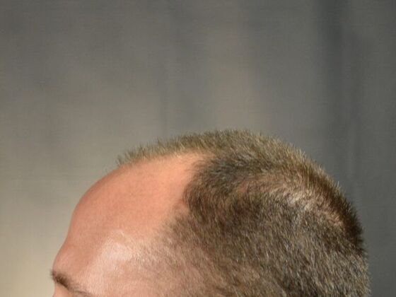 FUT Hair Restoration: Case 3 - Before
