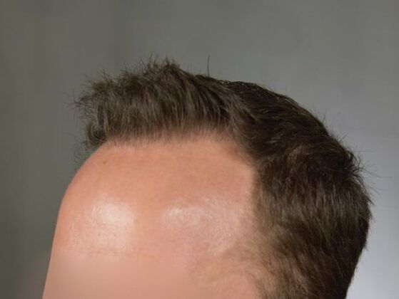 FUT Hair Restoration: Case 3 - After