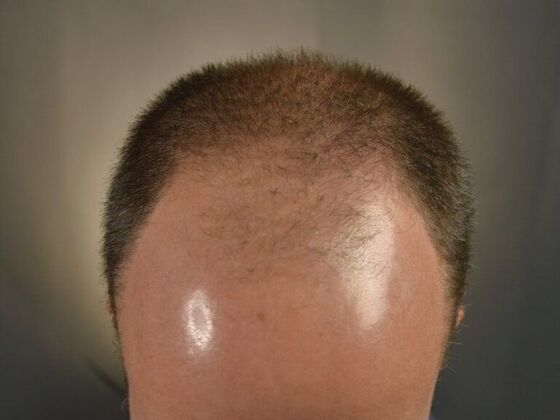 FUT Hair Restoration: Case 3 - Before