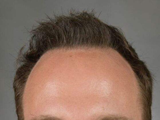 FUT Hair Restoration: Case 3 - After