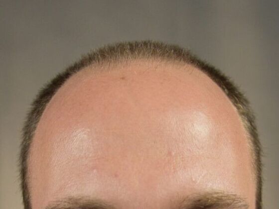 FUT Hair Restoration: Case 3 - Before