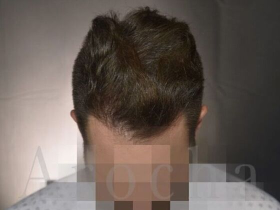 FUE Hair Restoration: Case 1 - After