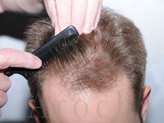 FUE Hair Restoration: Case 1 - Before