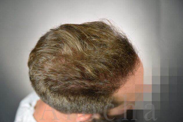 FUE Hair Restoration: Case 1 - After