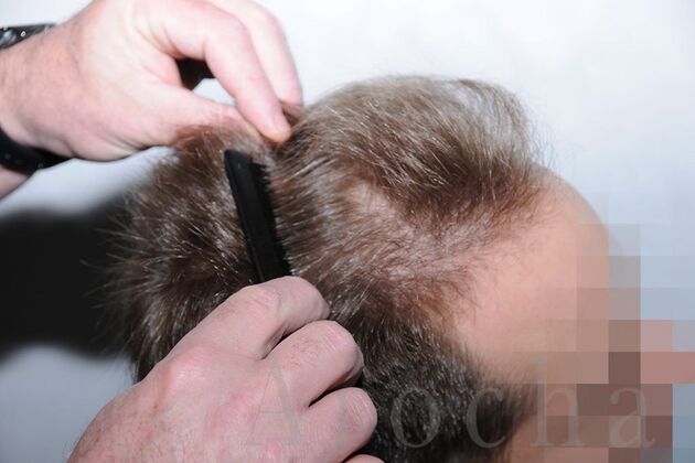 FUE Hair Restoration: Case 1 - Before