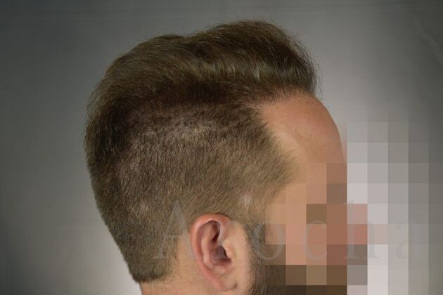 FUE Hair Restoration: Case 1 - After