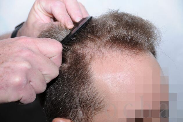 FUE Hair Restoration: Case 1 - Before