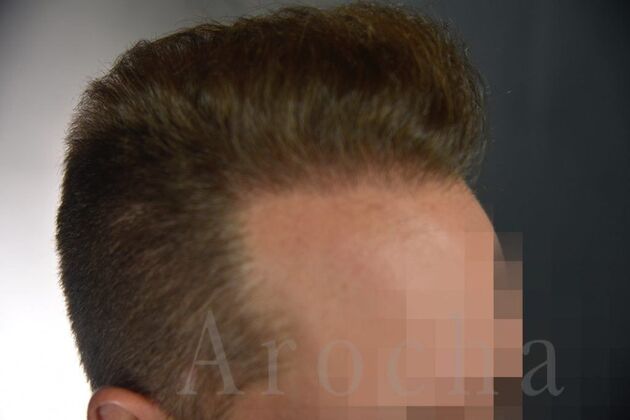FUE Hair Restoration: Case 1 - After
