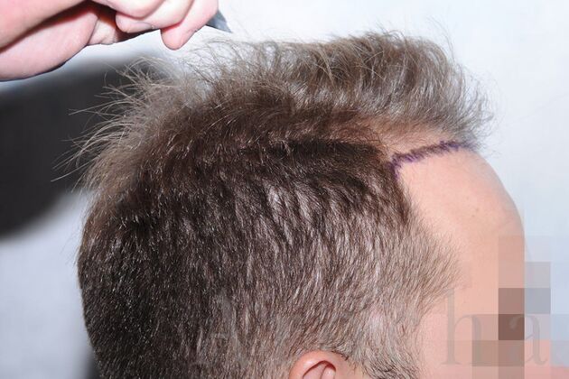 FUE Hair Restoration: Case 1 - Before
