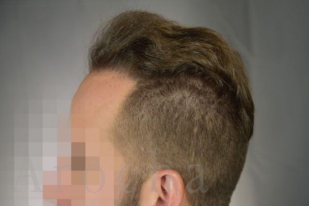 FUE Hair Restoration: Case 1 - After