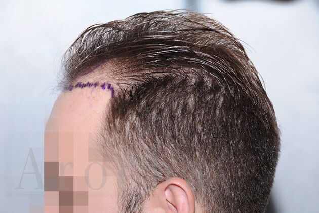 FUE Hair Restoration: Case 1 - Before