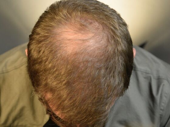 FUE Hair Restoration: Case 3 - After