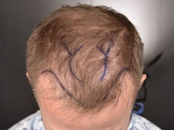 FUE Hair Restoration: Case 3 - Before