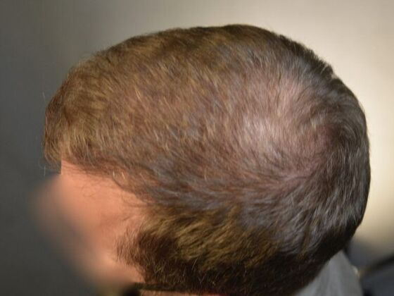FUE Hair Restoration: Case 3 - After
