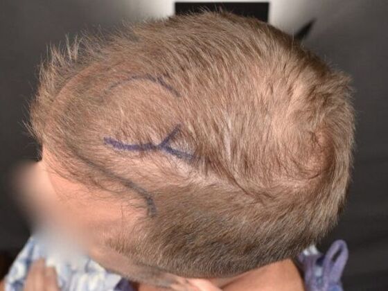 FUE Hair Restoration: Case 3 - Before