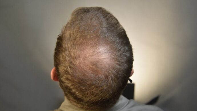 FUE Hair Restoration: Case 3 - After