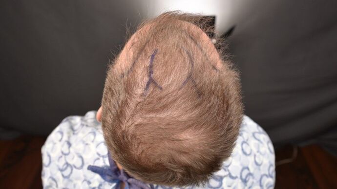 FUE Hair Restoration: Case 3 - Before