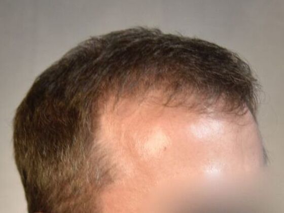 FUE Hair Restoration: Case 3 - After