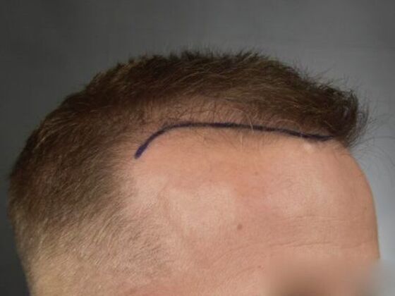 FUE Hair Restoration: Case 3 - Before
