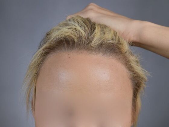 FUT Female: Case 1 - After