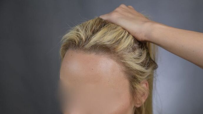 FUT Female: Case 1 - After