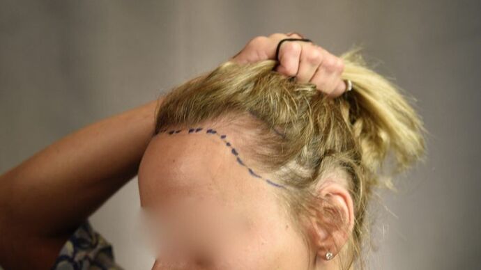 FUT Female: Case 1 - Before