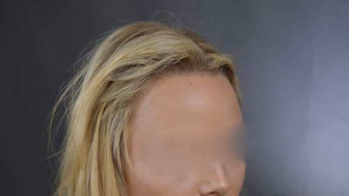 FUT Female: Case 1 - After