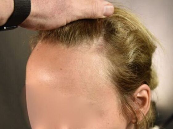 FUT Female: Case 1 - Before