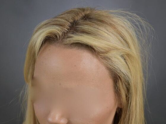 FUT Female: Case 1 - After