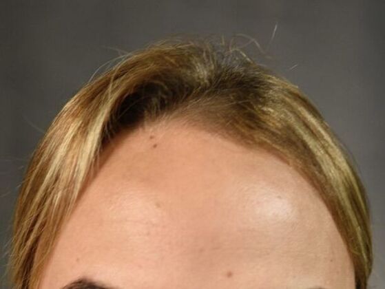 FUT Female: Case 1 - Before