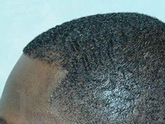 Ethnic Hair Restoration Case 1 - After