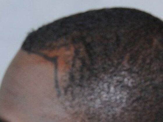 Ethnic Hair Restoration Case 1 - Before