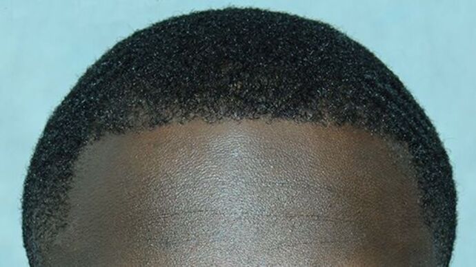 Ethnic Hair Restoration: Case 1 - After